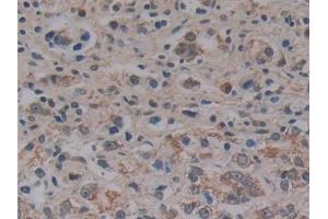 Detection of MFAP2 in Human Prostate cancer Tissue using Polyclonal Antibody to Microfibrillar Associated Protein 2 (MFAP2)