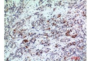 Immunohistochemistry (IHC) analysis of paraffin-embedded Human Breast Cancer, antibody was diluted at 1:200.