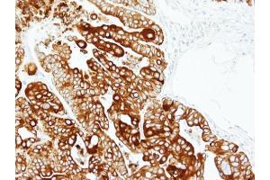 IHC-P Image Immunohistochemical analysis of paraffin-embedded N87 xenograft, using Cytokeratin 17, antibody at 1:100 dilution.