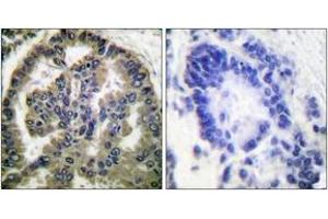 Immunohistochemistry analysis of paraffin-embedded human lung carcinoma tissue, using TGF beta2 Antibody. (TGFB2 anticorps  (AA 361-410))