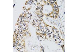 Immunohistochemistry of paraffin-embedded human gastric cancer using CHN1 antibody. (CHN1 anticorps  (AA 1-200))