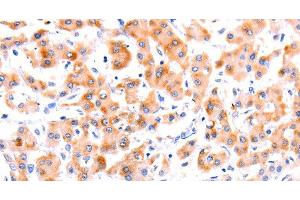Immunohistochemistry of paraffin-embedded Human liver cancer tissue using Ephrin A1 Polyclonal Antibody at dilution 1:37