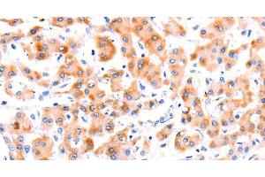 Immunohistochemistry of paraffin-embedded Human liver cancer tissue using Ephrin A1 Polyclonal Antibody at dilution 1:37 (Ephrin A1 anticorps)