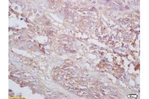 Formalin-fixed and paraffin embedded human lung carcinoma labeled with Rabbit Anti TNMD/tenomodulin Polyclonal Antibody, Unconjugated (ABIN872740) at 1:200 followed by conjugation to the secondary antibody and DAB staining (TNMD anticorps  (AA 151-250))