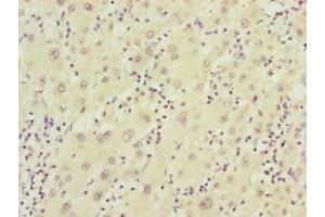 Immunohistochemistry of paraffin-embedded human liver cancer using ABIN7152411 at dilution of 1:100 (FBXO22 anticorps  (AA 104-403))