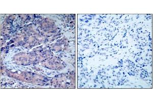 Immunohistochemical analysis of paraffin-embedded human breast carcinoma tissue, using SEK1/MKK4 (Ab-261) antibody (E021131). (MAP2K4 anticorps)