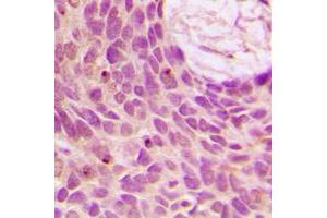Immunohistochemical analysis of SENP1 staining in human breast cancer formalin fixed paraffin embedded tissue section.