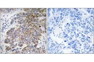 Immunohistochemistry analysis of paraffin-embedded human lung carcinoma tissue, using CHST10 Antibody. (CHST10 anticorps  (AA 191-240))