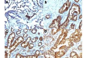 Immunohistochemical staining (Formalin-fixed paraffin-embedded sections) of human lung carcinoma (A), human prostate carcinoma (B), human duodenal carcinoma (C) and human colon carcinoma (D) with TTRAP monoclonal antibody, clone TDP2/1258 . (TDP2 anticorps)