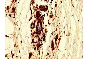 IHC image of ABIN7150454 diluted at 1:300 and staining in paraffin-embedded human breast cancer performed on a Leica BondTM system. (POLR3B anticorps  (AA 831-939))
