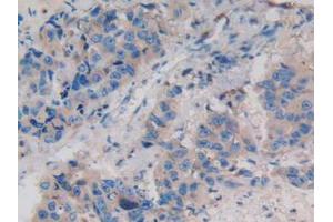 IHC-P analysis of Human Breast Cancer Tissue, with DAB staining. (WNT3A anticorps  (AA 19-352))