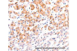 Immunohistochemistry of Human thyroid cancer using EFNA1 Polyclonal Antibody at dilution of 1:37 (Ephrin A1 anticorps)