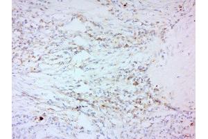 Formalin-fixed and paraffin embedded human laryngeal carcinoma labeled with Anti-MMP-2 Polyclonal Antibody, Unconjugated  at 1:200 followed by conjugation to the secondary antibody and DAB staining.