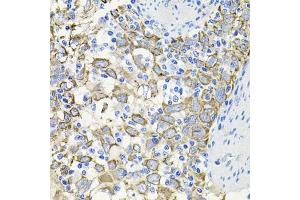 Immunohistochemistry of paraffin-embedded human esophageal cancer using A antibody (ABIN3015791, ABIN3015792, ABIN3015793 and ABIN6219141) at dilution of 1:100 (40x lens).