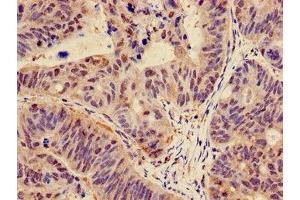 Immunohistochemistry of paraffin-embedded human colon cancer using ABIN7146988 at dilution of 1:100