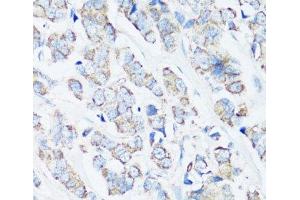 Immunohistochemistry of paraffin-embedded Human breast cancer using SRC Polyclonal Antibody at dilution of 1:100 (40x lens). (Src anticorps)