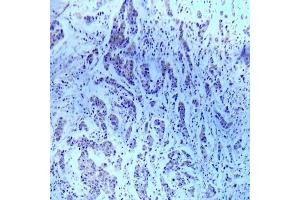 Immunohistochemical analysis of paraffin- embedded human breast carcinoma tissue using ASK1 (Ab-83) Antibody (E022058). (ASK1 anticorps)