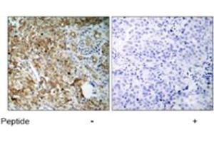 Immunohistochemical analysis of paraffin-embedded human breast carcinoma tissue using IGF1R polyclonal antibody  .