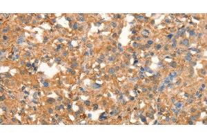 Immunohistochemistry of paraffin-embedded Human thyroid cancer using CRELD1 Polyclonal Antibody at dilution of 1:40 (CRELD1 anticorps)