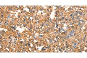 Immunohistochemistry of paraffin-embedded Human thyroid cancer using CRELD1 Polyclonal Antibody at dilution of 1:40 (CRELD1 anticorps)