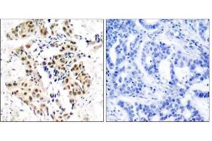 Immunohistochemical analysis of paraffin-embedded human breast carcinoma tissue using ATM (phospho-Ser1981) antibody (E011122). (ATM anticorps  (pSer1981))