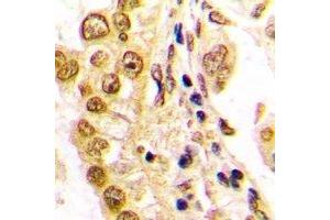 Immunohistochemical analysis of JUND staining in human lung cancer formalin fixed paraffin embedded tissue section.