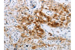 The image on the left is immunohistochemistry of paraffin-embedded Human lung cancer tissue using ABIN7191702(NPY2R Antibody) at dilution 1/20, on the right is treated with synthetic peptide. (NPY2R anticorps)