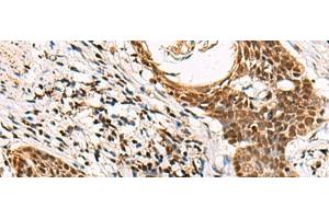 Immunohistochemistry of paraffin-embedded Human esophagus cancer tissue using GABPB1 Polyclonal Antibody at dilution of 1:70(x200) (GABPB1 anticorps)