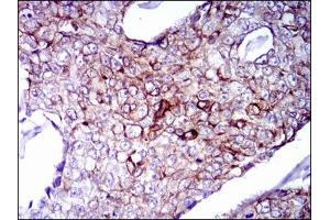 Immunohistochemical analysis of paraffin-embedded breast cancer tissues using CK5 antibody with DAB staining. (Cytokeratin 5 anticorps)