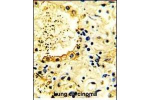 Formalin-fixed and paraffin-embedded human Lung carcinoma reacted with ACK1 Antibody (N-term), which was peroxidase-conjugated to the secondary antibody, followed by DAB staining.