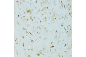 Immunohistochemistry of paraffin-embedded human uterine cancer using XBP1 antibody (ABIN6292352) at dilution of 1:100 (40x lens). (XBP1 anticorps)