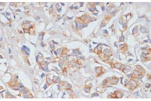 Immunohistochemistry of paraffin-embedded Human breast cancer using DLL1 Polyclonal Antibody at dilution of 1:100 (40x lens). (DLL1 anticorps)