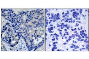 Immunohistochemical analysis of paraffin-embedded human breast carcinoma tissue, using Pyk2 (phospho-Tyr402) antibody (E011216). (PTK2B anticorps  (pTyr402))