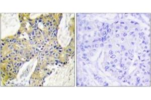 Immunohistochemistry analysis of paraffin-embedded human breast carcinoma tissue, using IARS2 Antibody. (IARS2 anticorps  (AA 71-120))