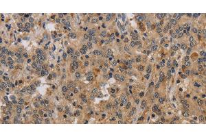 Immunohistochemistry of paraffin-embedded Human liver cancer tissue using ELAVL2 Polyclonal Antibody at dilution 1:40