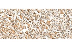 Immunohistochemistry of paraffin-embedded Human liver cancer tissue using PLBD1 Polyclonal Antibody at dilution of 1:25(x200) (PLBD1 anticorps)