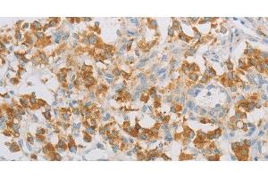 Immunohistochemistry of paraffin-embedded Human thyroid cancer tissue using REN Polyclonal Antibody at dilution 1:40 (Renin anticorps)