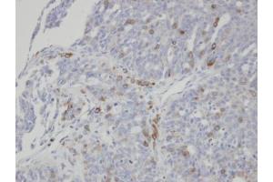 IHC-P Image Immunohistochemical analysis of paraffin-embedded human serous ovarian cancer, using ST3GAL1, antibody at 1:100 dilution. (ST3GAL1 anticorps)