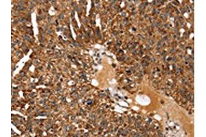 The image on the left is immunohistochemistry of paraffin-embedded Human breast cancer tissue using ABIN7129957(KCNH6 Antibody) at dilution 1/30, on the right is treated with fusion protein. (KCNH6 anticorps)