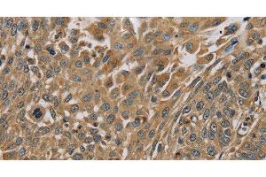 Immunohistochemistry of paraffin-embedded Human lung cancer using MYL3 Polyclonal Antibody at dilution of 1:45 (MYL3/CMLC1 anticorps)