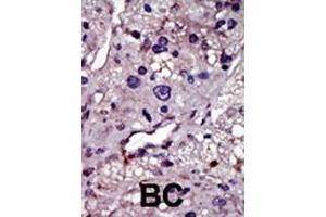Formalin-fixed and paraffin-embedded human cancer tissue reacted with the primary antibody, which was peroxidase-conjugated to the secondary antibody, followed by AEC staining.