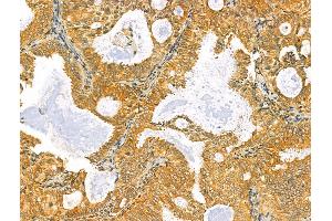 ABIN6264681 and ABIN6273070 at 1/100 staining Human lung cancer by IHC-P. (RCN2 anticorps  (C-Term))