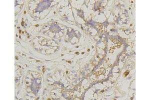 Immunohistochemistry of paraffin-embedded human mammary cancer using SLC2A1 antibody (ABIN5997113) at dilution of 1/100 (40x lens). (GLUT1 anticorps)