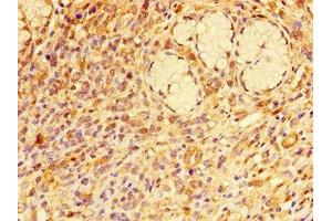 Immunohistochemistry of paraffin-embedded human gastric cancer using ABIN7167377 at dilution of 1:100 (RAB7A anticorps  (AA 110-177))