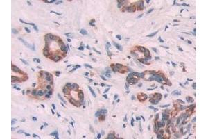 Detection of KRT6C in Human Pancreatic cancer Tissue using Polyclonal Antibody to Keratin 6C (KRT6C) (Keratin 6C anticorps  (AA 163-482))