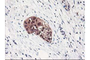 Immunohistochemical staining of paraffin-embedded Adenocarcinoma of Human breast tissue using anti-NIF3L1 mouse monoclonal antibody. (NIF3L1 anticorps)