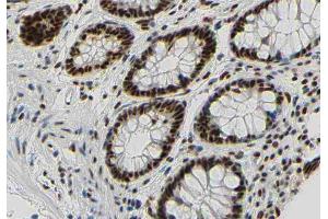 ABIN6267350 at 1/200 staining human colon carcinoma tissue sections by IHC-P.