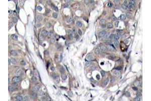 Immunohistochemistry analyzes of HSP27 antibody in paraffin-embedded human breast carcinoma tissue. (HSP27 anticorps)
