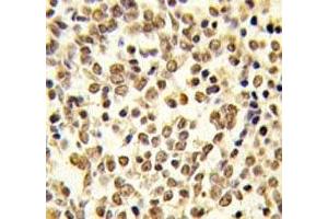 IHC analysis of FFPE human kideny carcinoma tissue stained with ERK5 antibody (MAPK7 anticorps  (AA 776-805))