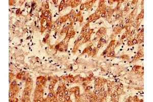 Immunohistochemistry analysis of human liver tissue using ABIN7169364 at dilution of 1:100 (SAA1 anticorps  (AA 20-122))